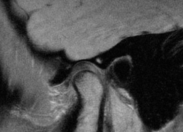 Curso Resonancia MagnÃ©tica de la ArticulaciÃ³n Temporomandibular
