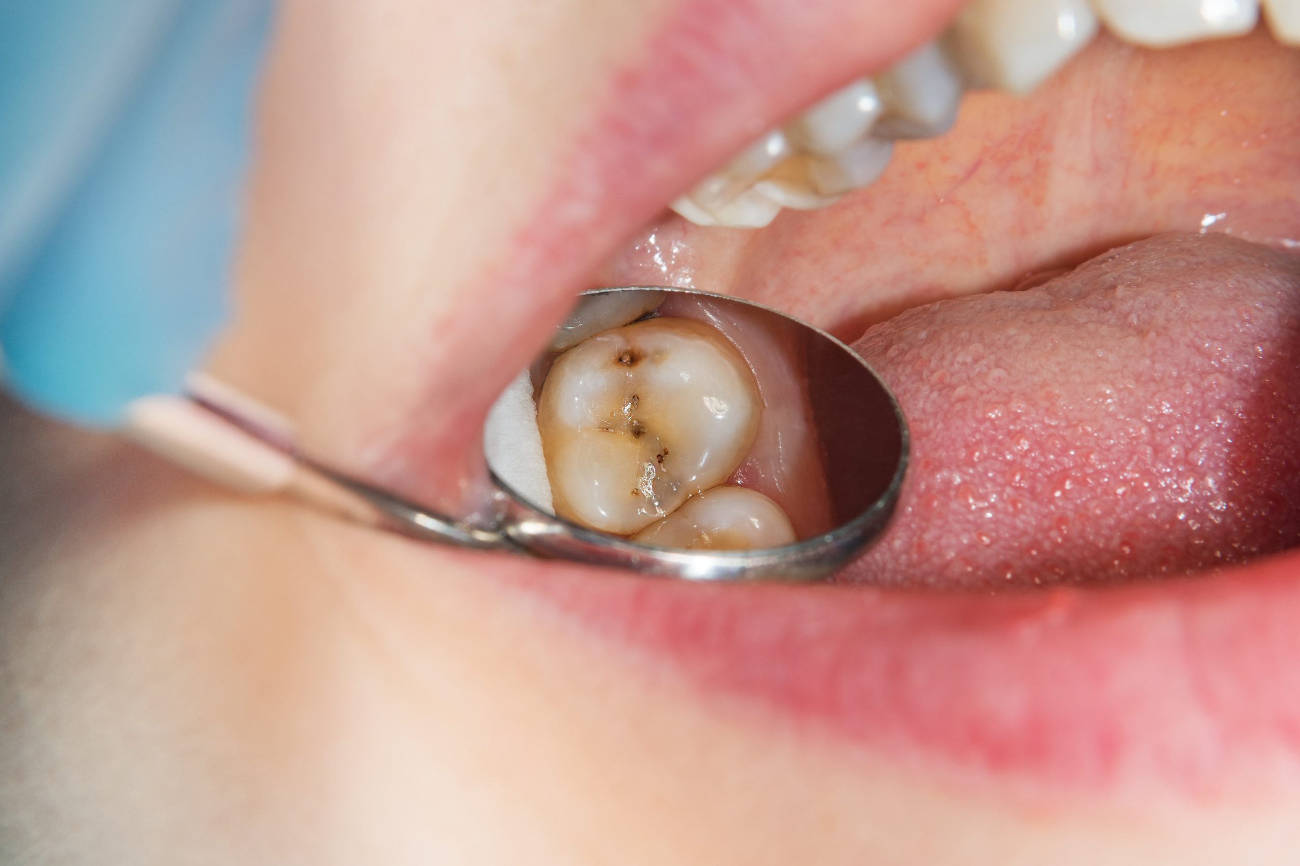 Curso de CalibraciÃ³n TeÃ³rica PrÃ¡ctica en Criterio de DetecciÃ³n de Caries ICDAS-ICCMS
